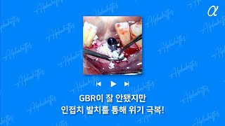 인접치 전략적 발치를 통해 마무리!