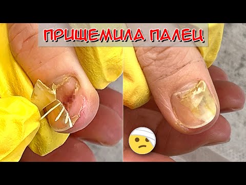 Прищемила палец дверью / Сошел ноготь на руке, что делать?