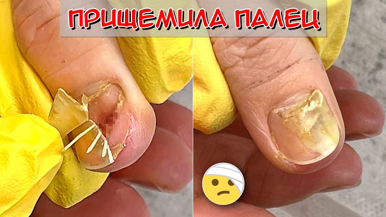Прищемила палец дверью машины