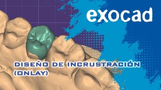 DISEÑO DE INCRUSTACION (ONLAY) | EXOCAD