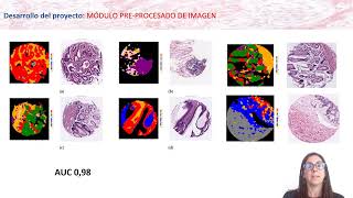 Predicción de inestabilidad de microsatélites en cáncer colon a partir de hematoxilina-eosina