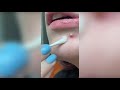 Popping huge blackheads and Pimple Popping - Best Pimple Popping Videos #41