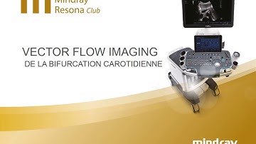 Vector Flow Imaging de la bifurcation carotidienne