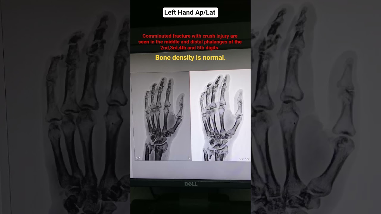 Xray left hand ap oblique // ✋🏻