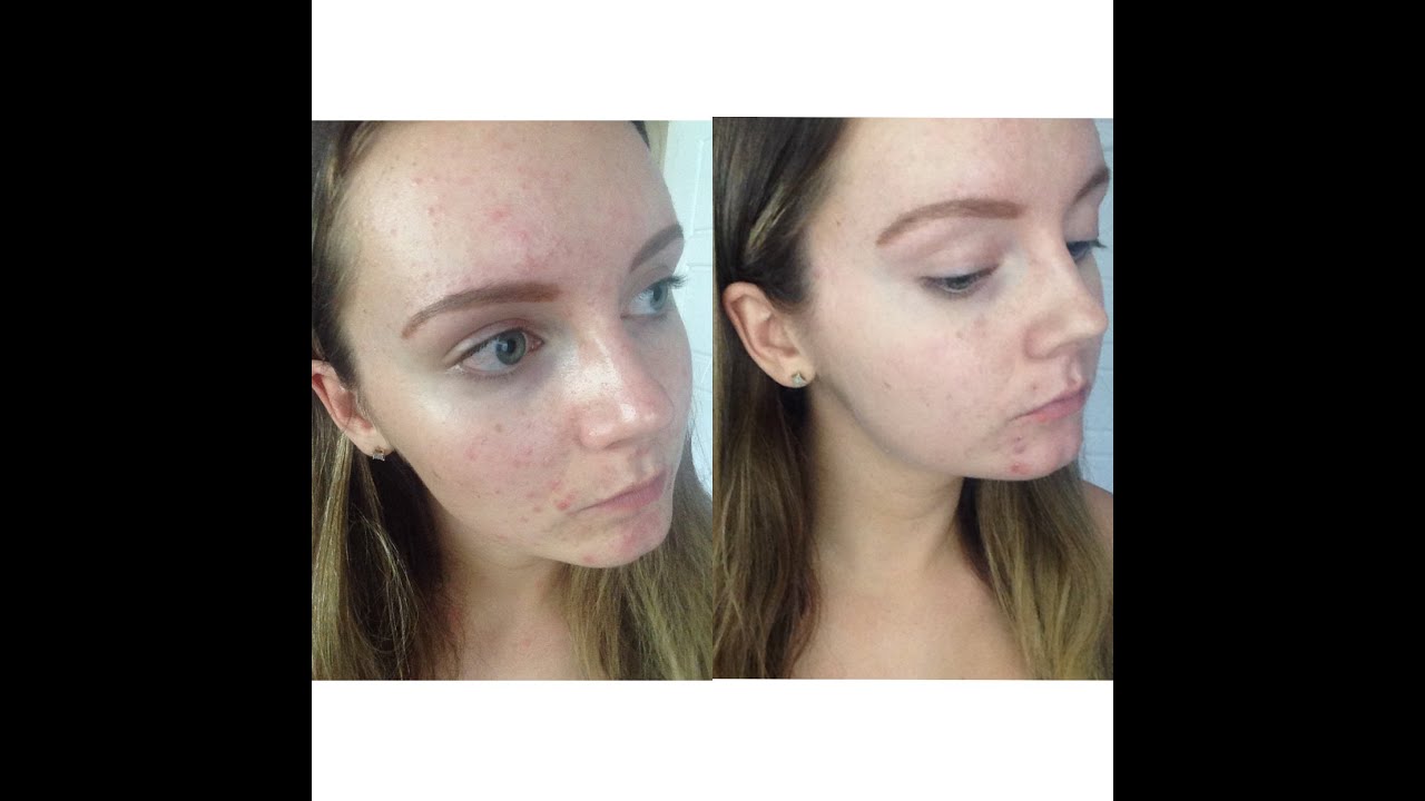 Isotretinoin For Acne Reviews