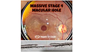 Stage 4 Full Thickness Macular Hole