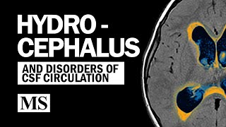 Hydrocephalus And the Disorders of CSF Circulation by The Neurophile (by Rutgers RWJMS Neurology) 88,567 views 3 years ago 35 minutes