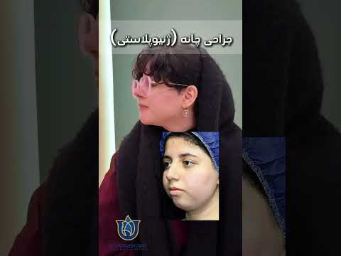 يك ماه بعد از جراحى چانه به روش ژنيوپلاستى بدون جسم خارجى و پروتز و به صورت دايم دكتر مانى آرش راد