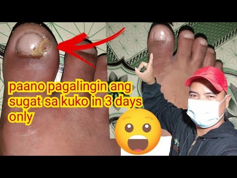 PAANO MAPAPAGALING ANG SUGAT SA TAGILIRAN NG KUKO SA PAA. - YouTube