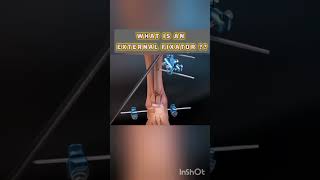 what is an external Fixator???#orthopedics #externalfixator #bonehealth #tibiafracture #educational