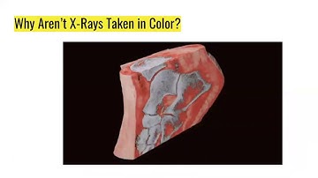 Deep Learning & Pneumonia Detection