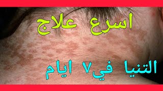 علاج التينيا الملونة علاج فطريات التينيا