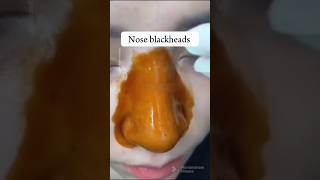 Nose Blackheads/Whiteheads Removal in 1 Day|Get Glass Skin on Nose ? glowingskin shorts skincare