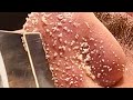 【acne pimple】やみつき角栓Part95
