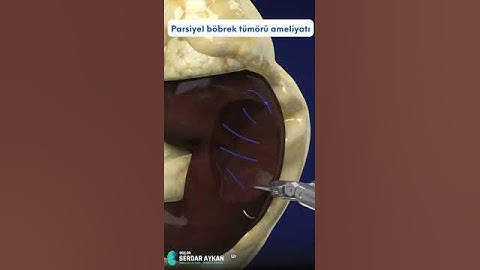 PARSİYEL NEFREKTOMİ, NEFRON KORUYUCU TEDAVİ. ROBOTİK PARSİYEL NEFREKTOMİ. DOÇ DR SERDAR AYKAN