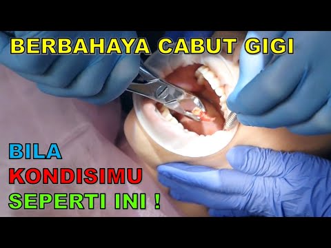 Video: Haruskah gigi yang berdekatan sakit setelah pencabutan?