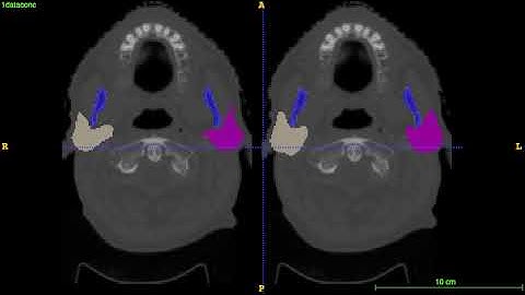 AnatomyNet-for-anatomical-segmentation test demo 1