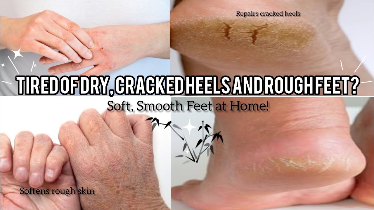 Best DIY Cream for Cracked Heels & Rough hands| Soft, Smooth at Home!