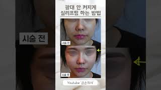 실리프팅하면 광대가 도드라져서 커보인다?