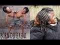 Conjoined Twins Special | BORN DIFFERENT