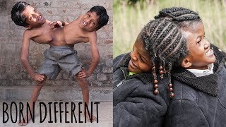 Conjoined Twins Special | BORN DIFFERENT