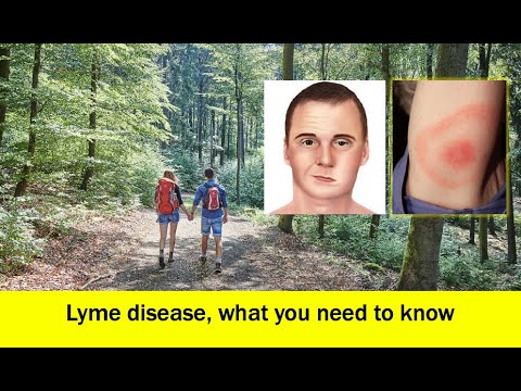 วีดีโอ: วิธีการรักษา Post Lyme Disease Syndrome: 14 ขั้นตอน (พร้อมรูปภาพ)