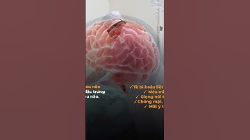 Dấu hiệu đột quỵ trước 1 tuần bạn nhất định phải biết