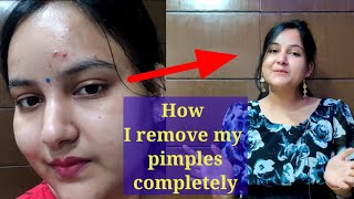 मैंने पिंपल से छुटकारा पाकर अपनी skin clear कैसे किया /I remove pimples completely #pimplesfreeskin