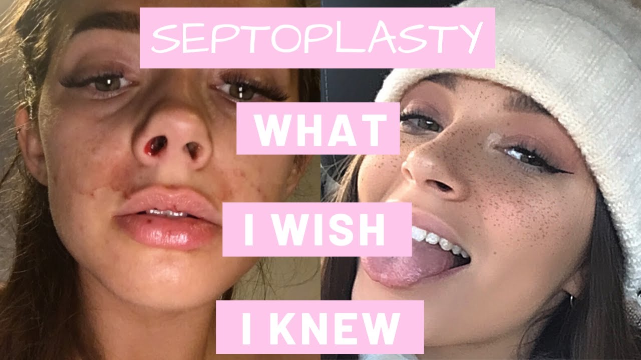 How To Survive A Septoplasty | What I Wish I Knew
