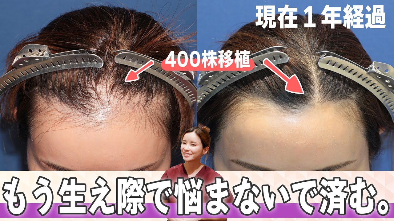 Dr.今川の植毛体験記 専門医が自分の髪で実践したドキュメント 最先端の自毛植… maxresdefault.jpg