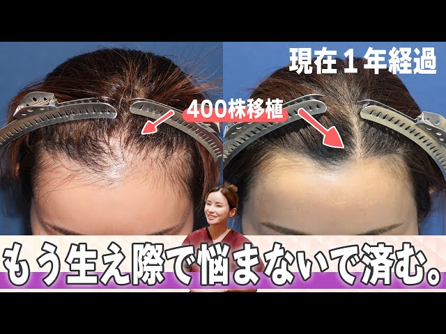 Dr.今川の植毛体験記 専門医が自分の髪で実践したドキュメント 最先端の自毛植… sddefault.jpg