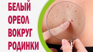 Белый ореол вокруг родинки