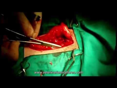 Cirugia Laparoscopica De La Hernia Inguinal En Nueva York