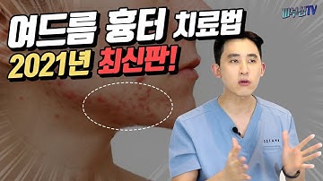 여드름 흉터 없애는 치료방법 2021 최신판! [피부과전문의 피부심]