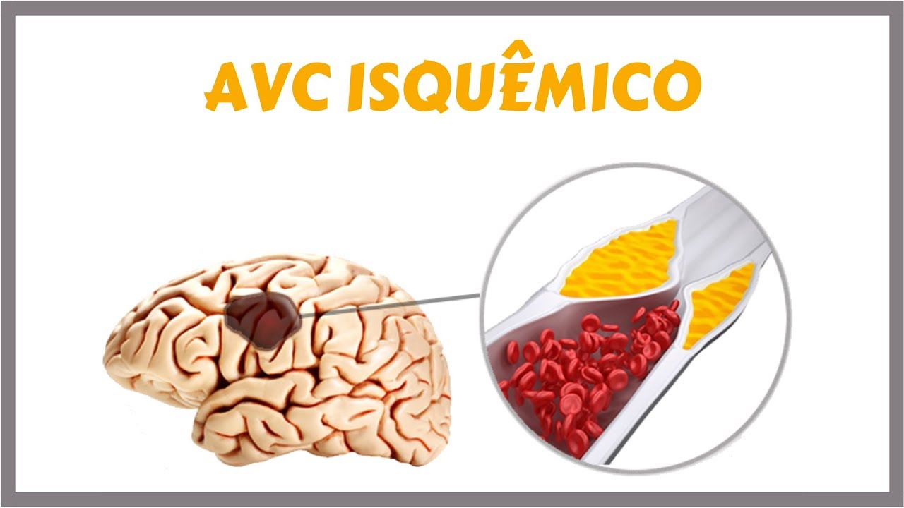 Resumo Sobre O Acidente Vascular Encefalico Isquemico Ligas Sanar Images