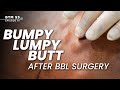 Bumpy Butt After BBL? Don't Panic! | BTM 5 EP.1