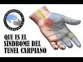 Sindrome del tunel carpiano, que es y porque se produce