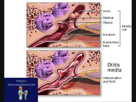 Tube Surgery Ear, Surgery for Kids - Surgery Indic...