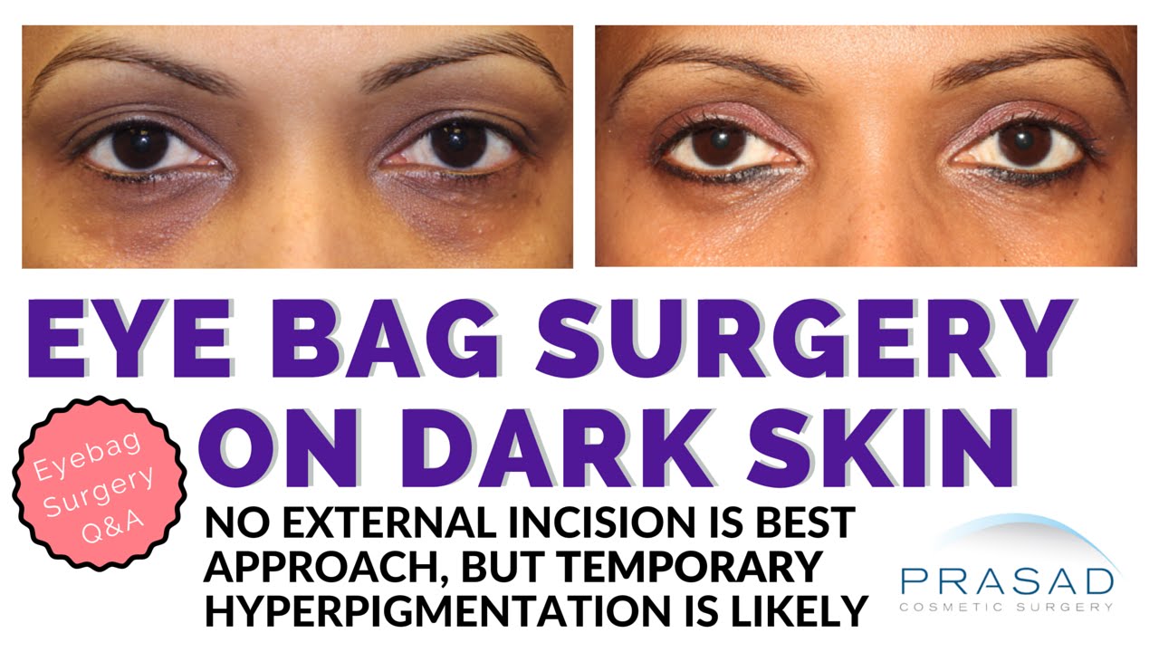 Reasons to undergo eyelid bag surgery  Dr V S Rathore