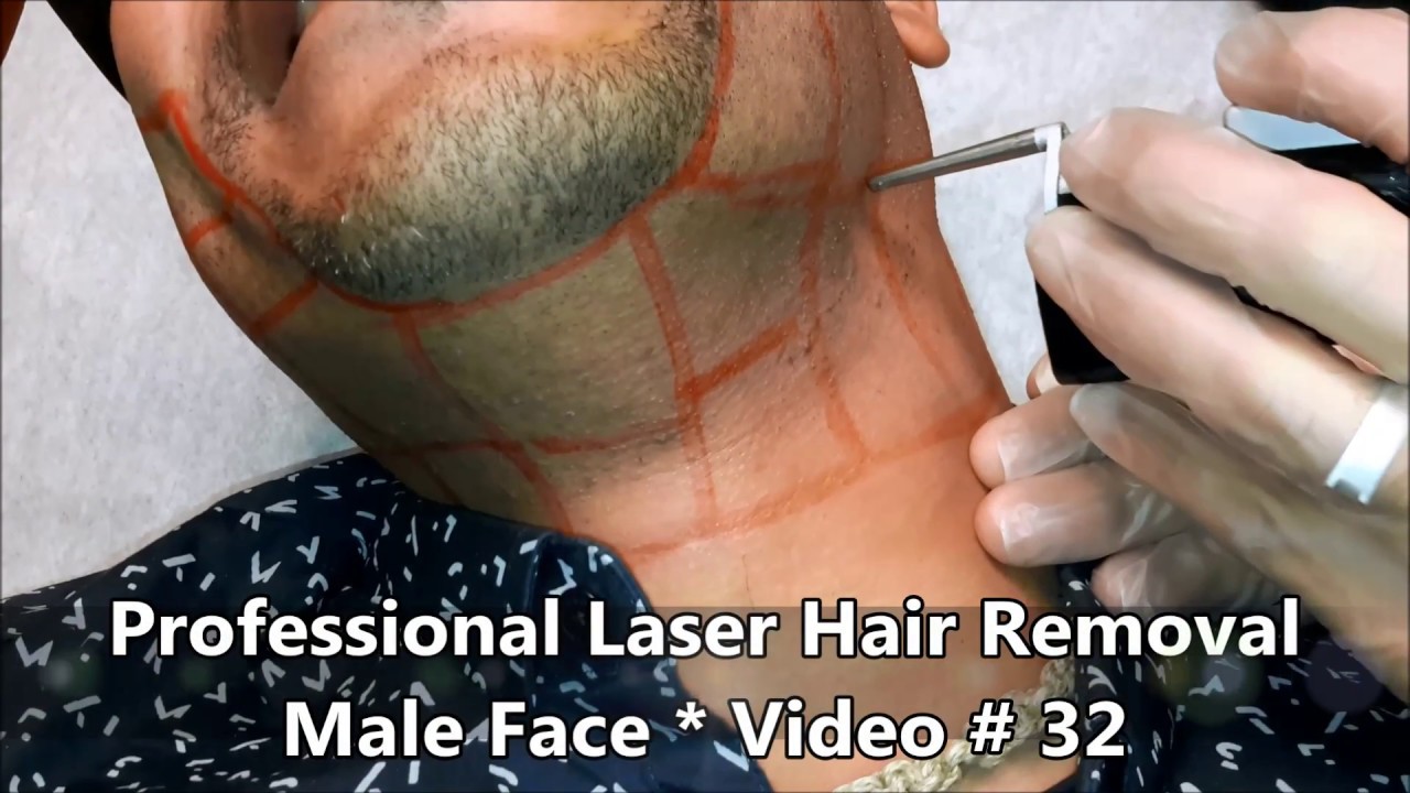 Professional Laser Hair Removal - Male Face -Video # 32 - YouTube