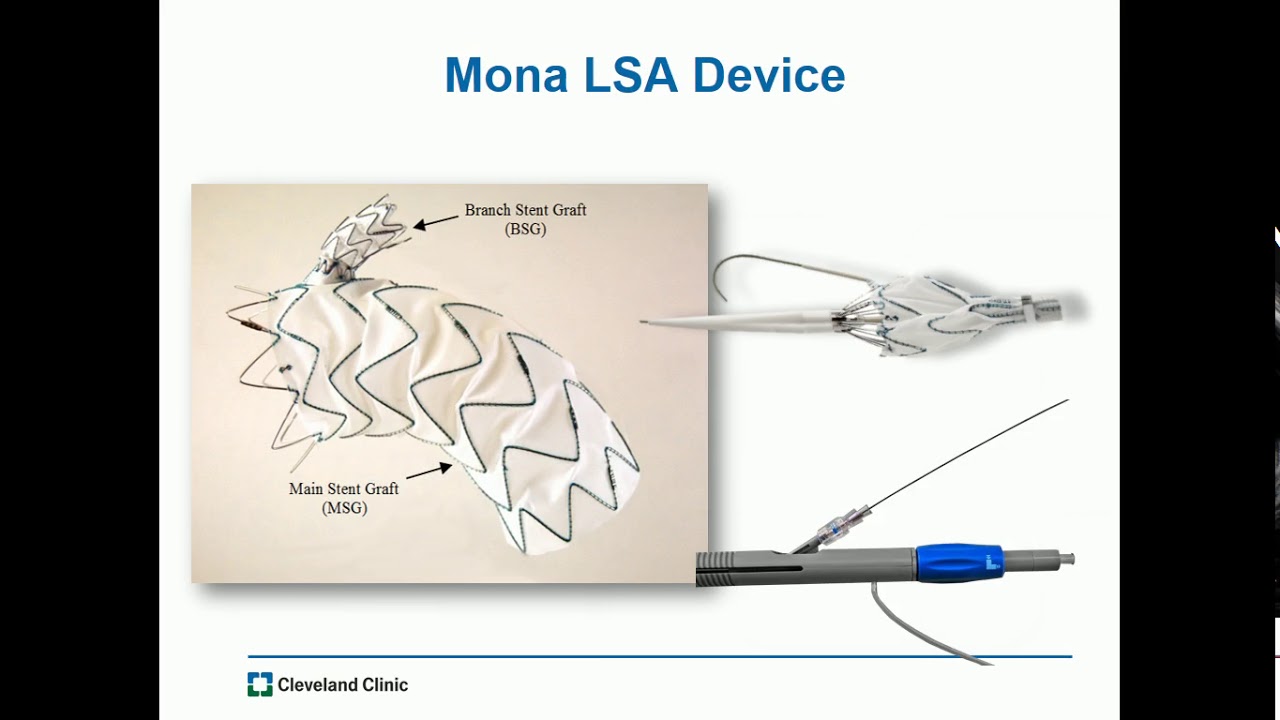 10.40-10.50: Tips and Tricks of Branched Left Subclavian Stent Grafts, Eric E. Roselli, MD