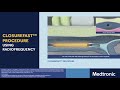 Treatment for varicose veins  closurefast procedure  medtronic india