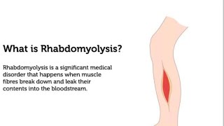  Definition,causes and Clinical features of Rhabdomyolysis..