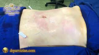 عمل لیپو و تزریق چربی به باسن | دکتر پرویزیان  | Liposuction and fat injection into the buttocks