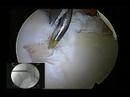 Hip Labral Repair