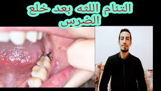 علاج التهابات اللثه بعد خلع الضرس (مكان الضرس مفتوح)