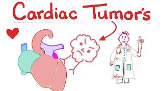 Heart Tumors  Myxoma, Rhabdomyoma, Leiomyosarcoma   Cardiology Playlist