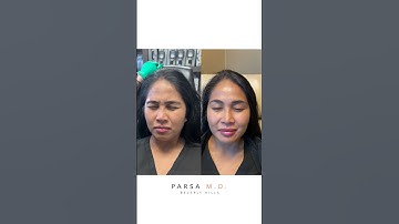 Xeomin Results for Crow