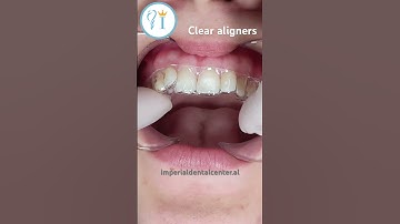 Clear Aligners - This is how you put them 🦷#aligner #dentist #dental #teeth #clearaligners