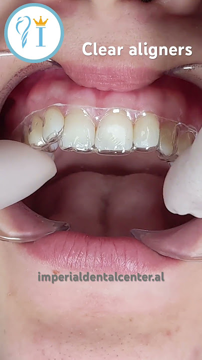 Clear Aligners - This is how you put them 🦷#aligner #dentist #dental #teeth #clearaligners